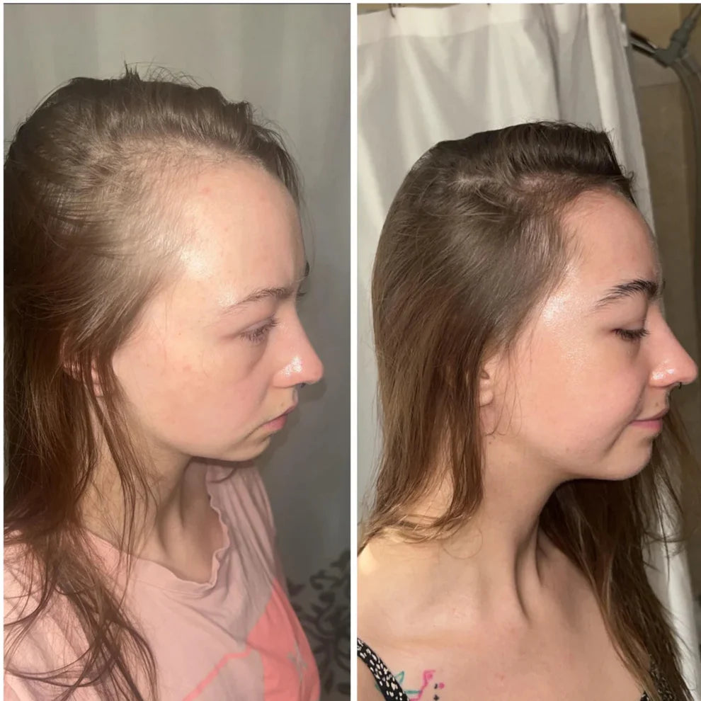 StyleSparkz 5% Minoxidil Advanced Formula Hair Growth Serum